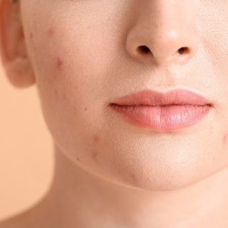 An In-depth Look at Natural and Medicinal Face Acne Treatment Solutions